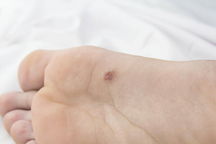 Verruca or Wart? What a Verruca Looks Like, Whether It's Contagious and How to Get Rid of It