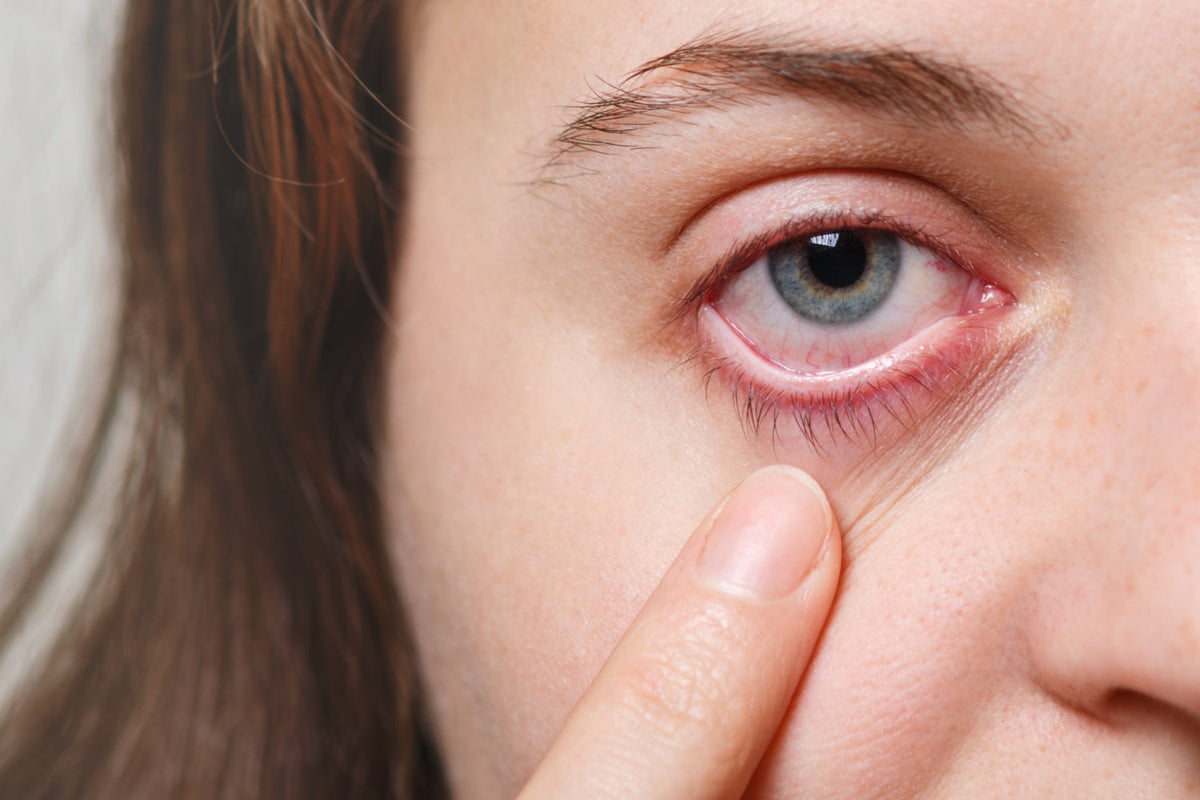 Close-up of a woman pulling down her lower eyelid to show a red, irritated eye
