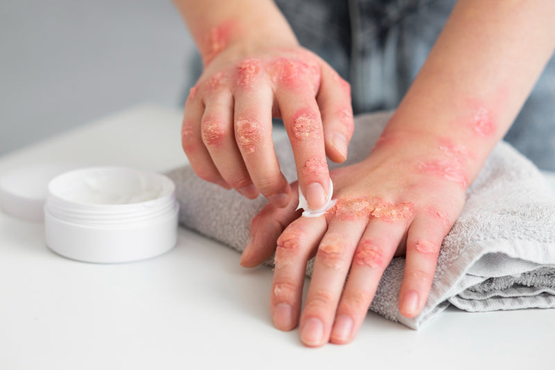 Psoriasis