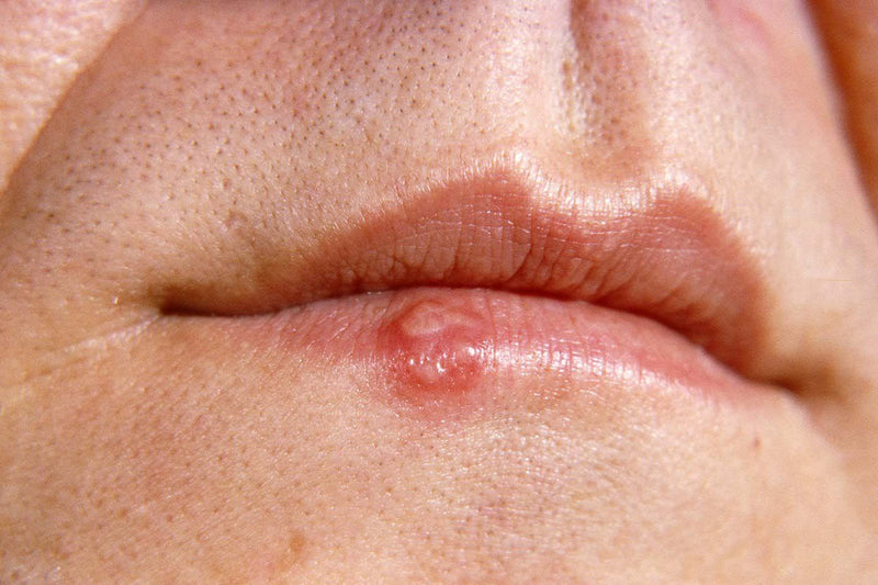 Cold Sores